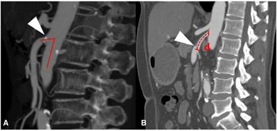 Different hemodynamic factors cause the occurrence of superior mesenteric atherosclerotic stenosis and superior mesenteric artery dissection